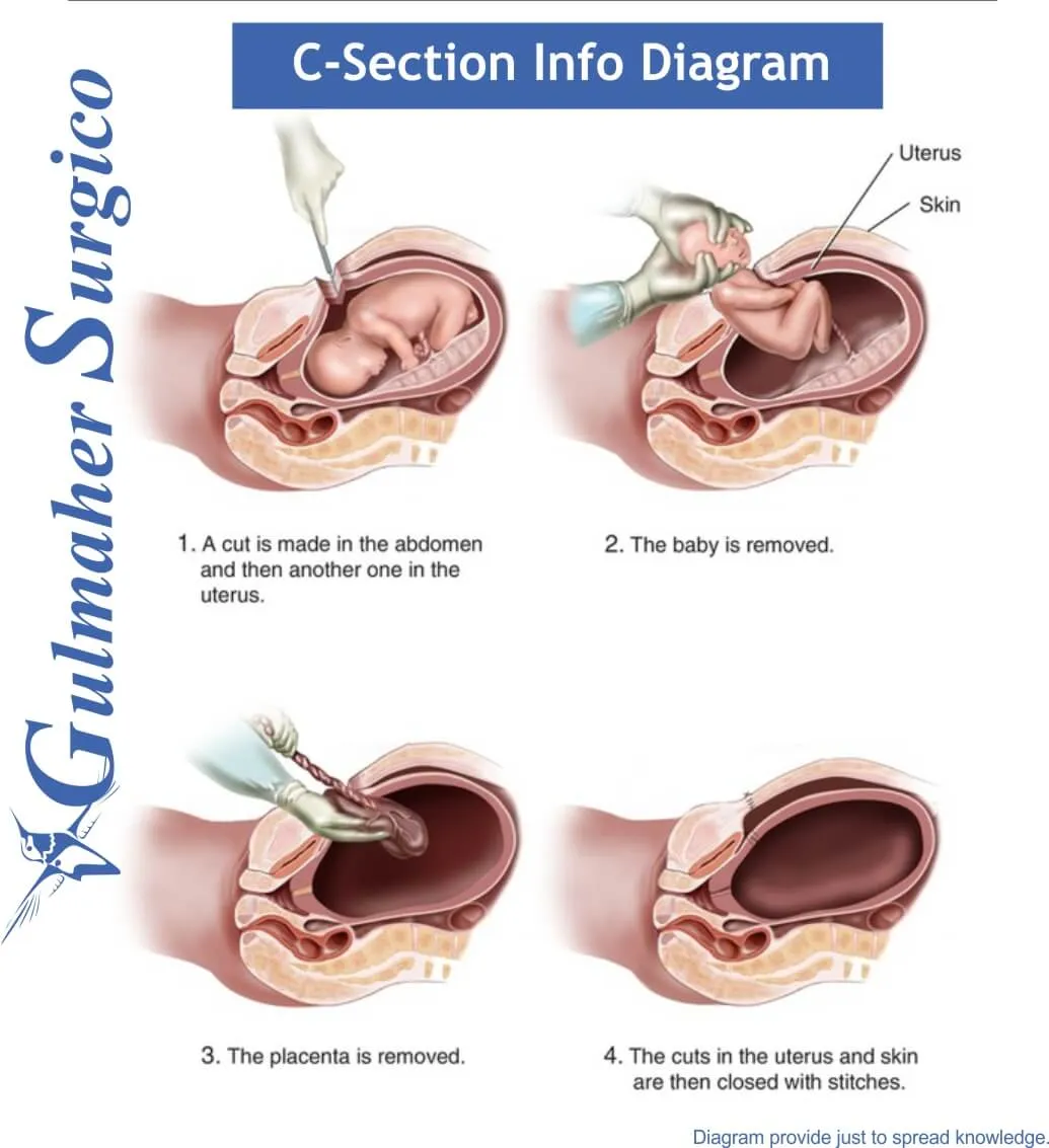 D and C-Section