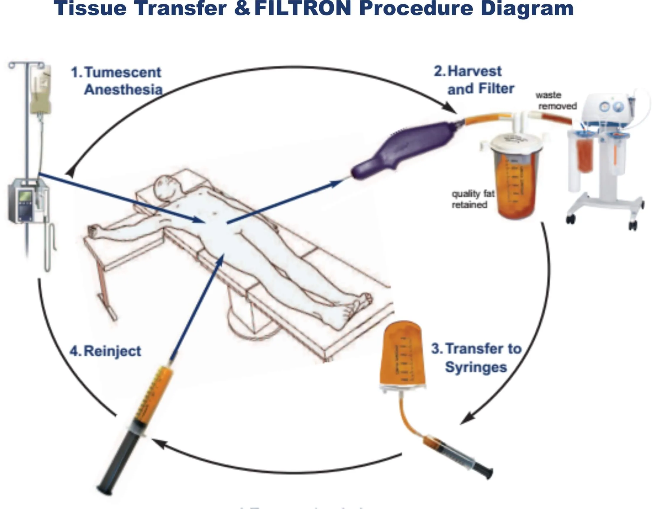 Fat Transfer Procedure Liposuction procedure Diagram.